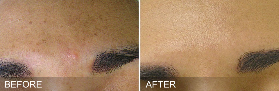 Hydrafacial MD Blue Bell Hydrafacial MD Blue Bell