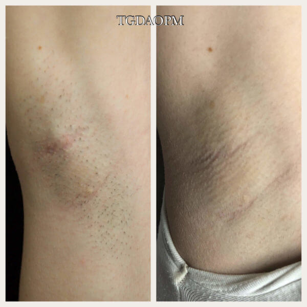 Motus AX Laser Hair Removal Blue Bell Motus AX Laser Hair Removal Blue Bell