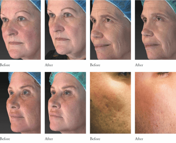 Vivace RF Microneedling Blue Bell Vivace RF Microneedling Blue Bell