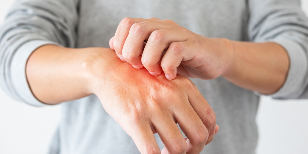 The Differences Between Rashes and Eczema (And How to Tell Which One You  Have)