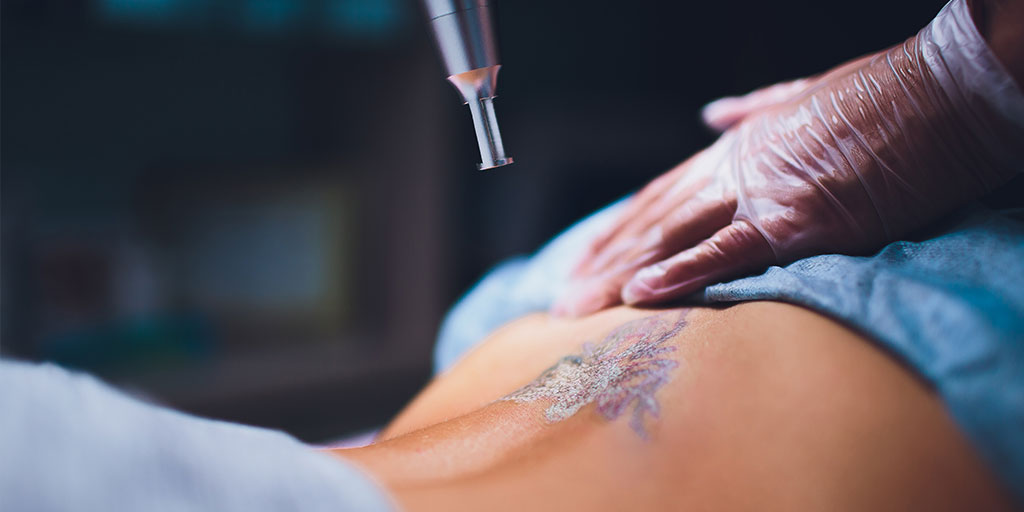 The Laser Tattoo Removal Healing Process | Removery