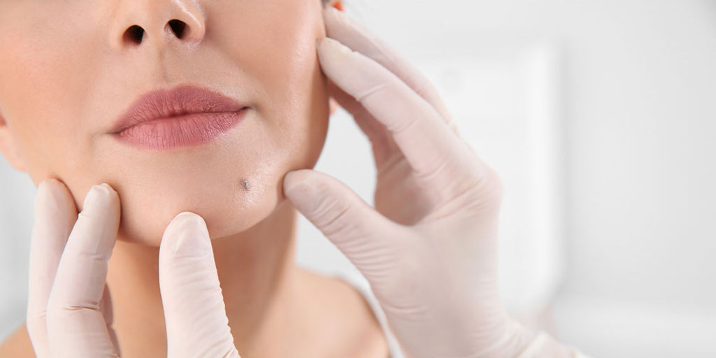 Doctor checking a mole on a woman's face.