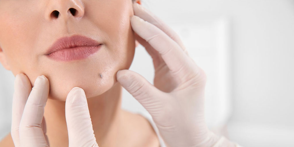 How do we remove moles?! If you have a mole on your face, seeing a