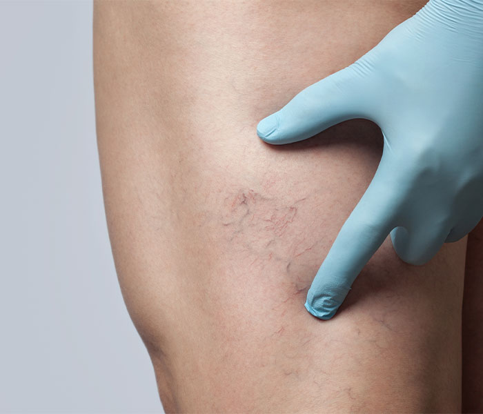 Sclerotherapy for Varicose Veins - Vein & Endovascular Medical Care