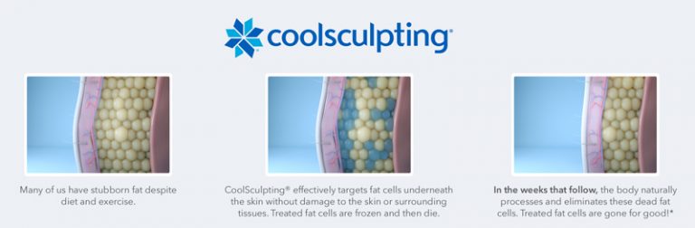 Which Parts Of The Body Can Coolsculpting® Be Used On Plymouth Meeting Dermatology