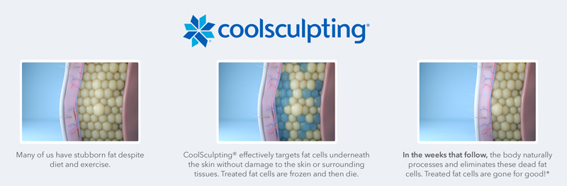 Coolsculpting