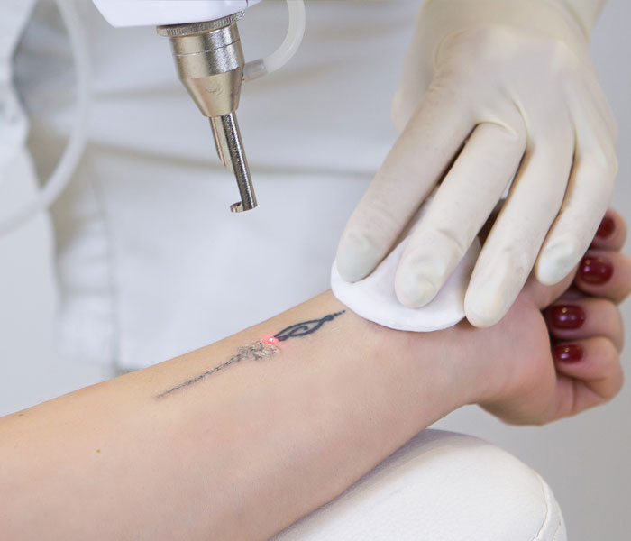 Does tattoo removal hurt? It can, but there's good news — True Skin  Cosmetic & Laser Clinic