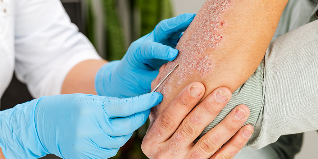 Is Psoriasis Linked To Cancer Dermatology Associates Of Plymouth Meeting 