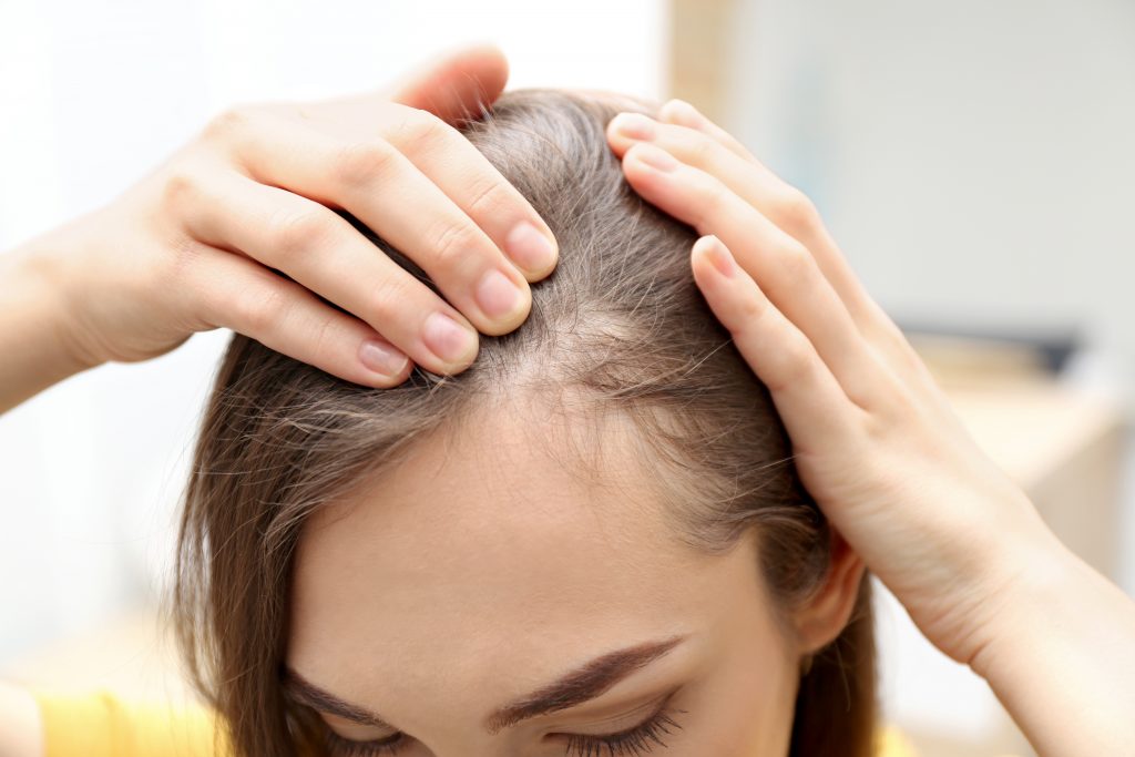 Young woman with hair loss problem indoors, closeup