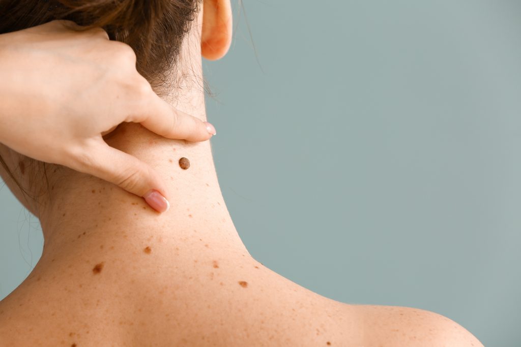 Dermatologist examining moles of patient on grey background