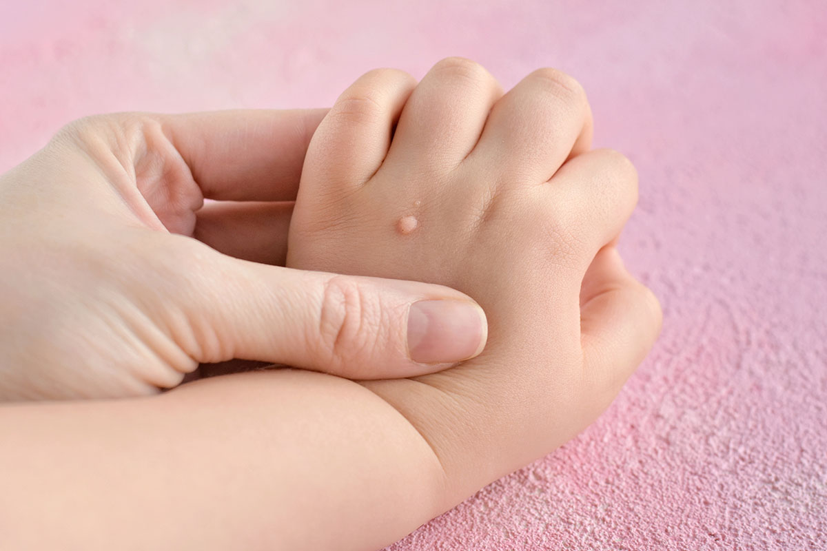 The doctor holds a small hand of a child affected with warts wit