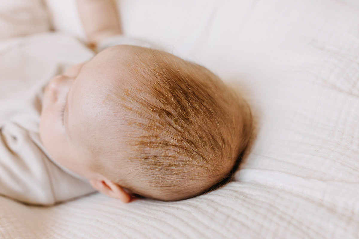 Closeup of baby head with cradle cap. Dry skin on baby scalp.