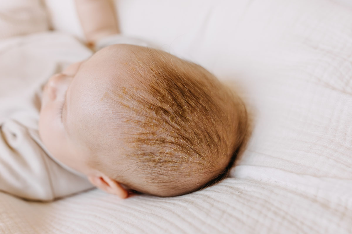 Cradle Cap Just Dry Skin at Wesley Poulson blog