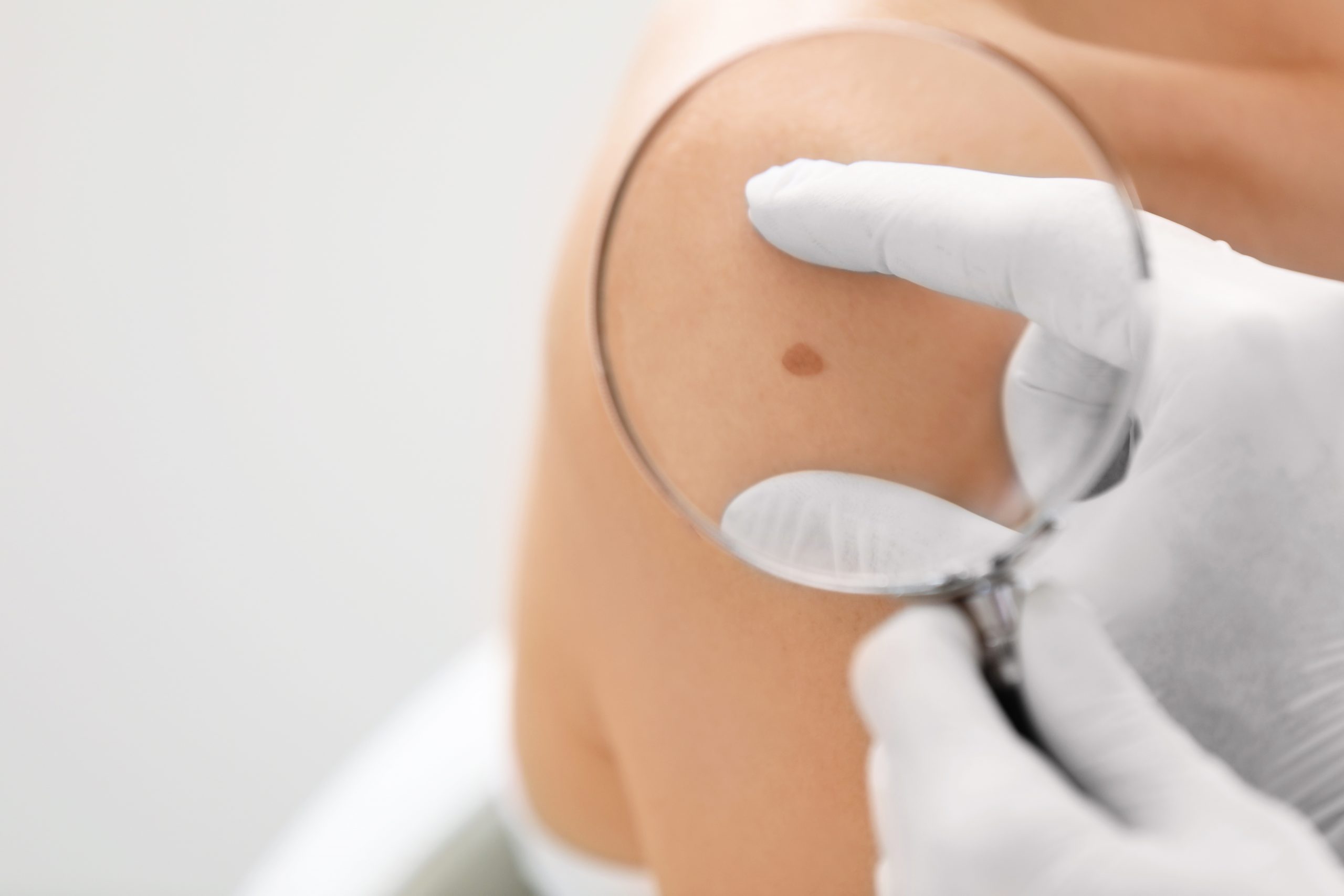 Dermatologist examining birthmark of patient, closeup. Cancer concept