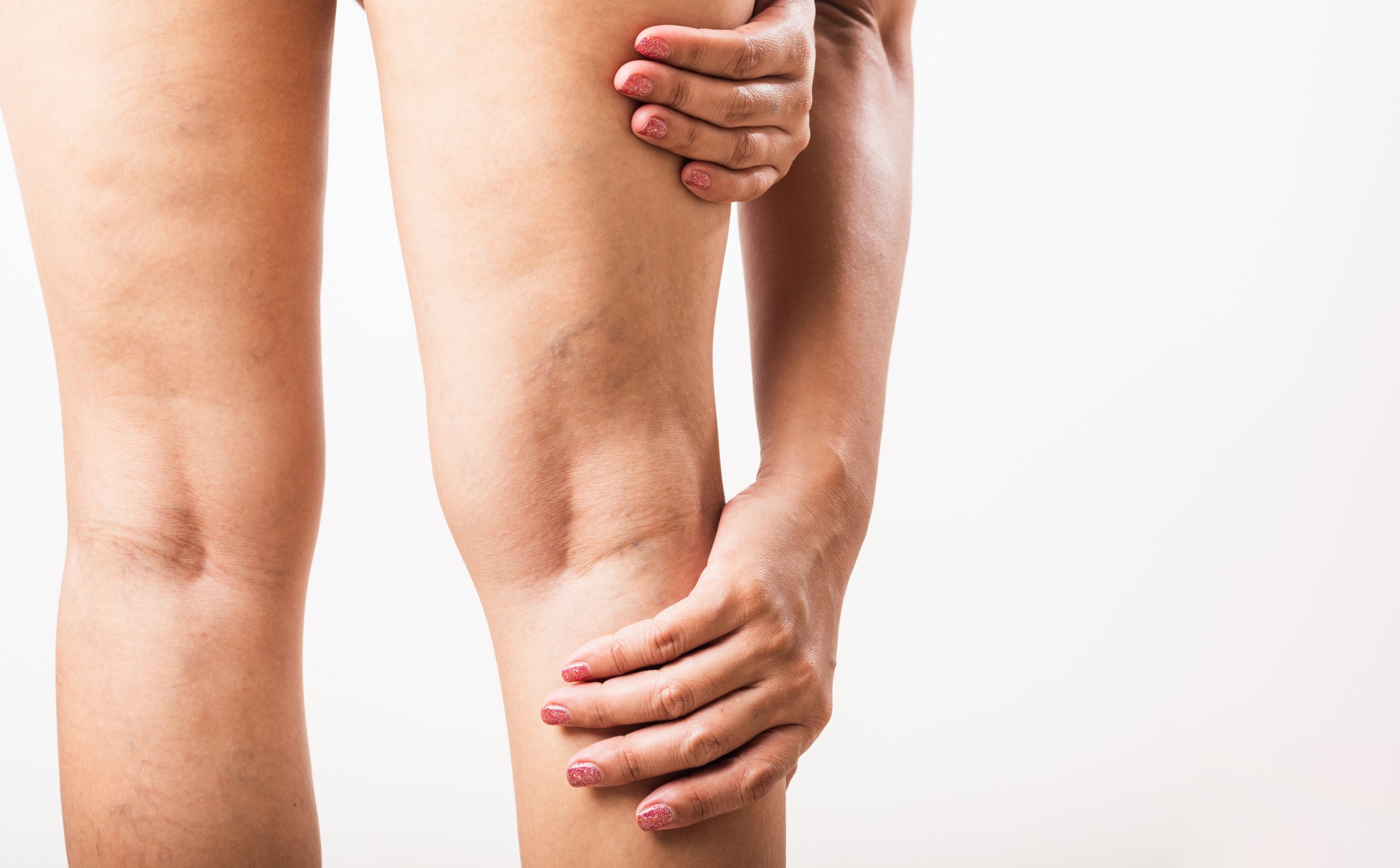 Closeup young Asian woman painful varicose and spider veins on leg, studio shot isolated on white background, Healthcare medical and hygiene skin body varicose veins problems care concept