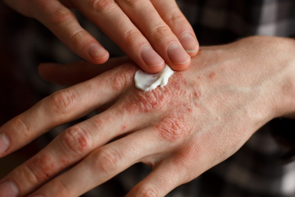 Nail Psoriasis: Diagnosis and Treatment Options — Drought Skin