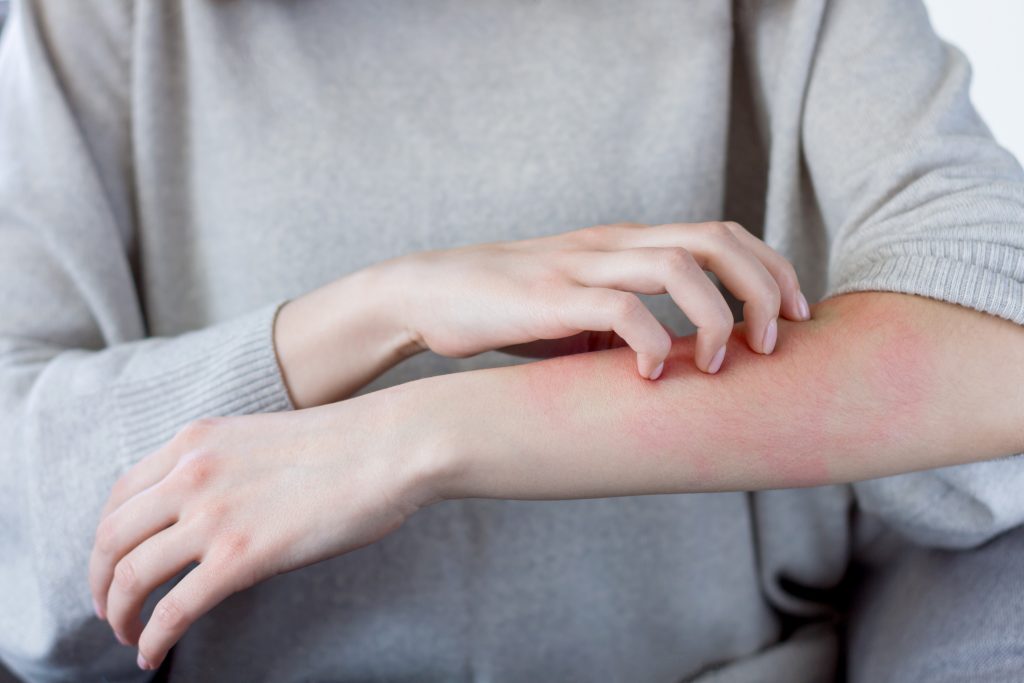 woman scratching her itchy back with allergy rash Stock Photo