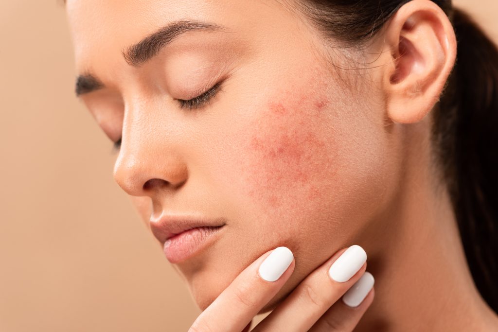 Inflammation on the skin of the face. Red pimples purulent. Acne. Keloid  scars. Expanded pores Stock Photo - Alamy