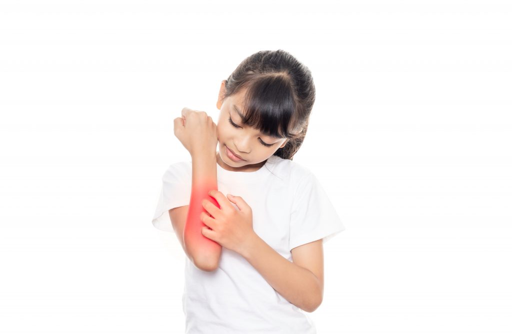 Little girl has skin rash allergy and itchy on her arm isolated on white background with clipping path.