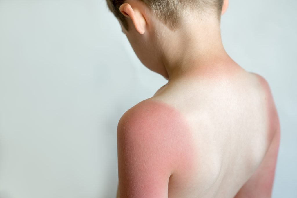 Sunburn on a child's back. Strong tan in the boy. Red hands and back. Sore skin, blistered. No sun protection