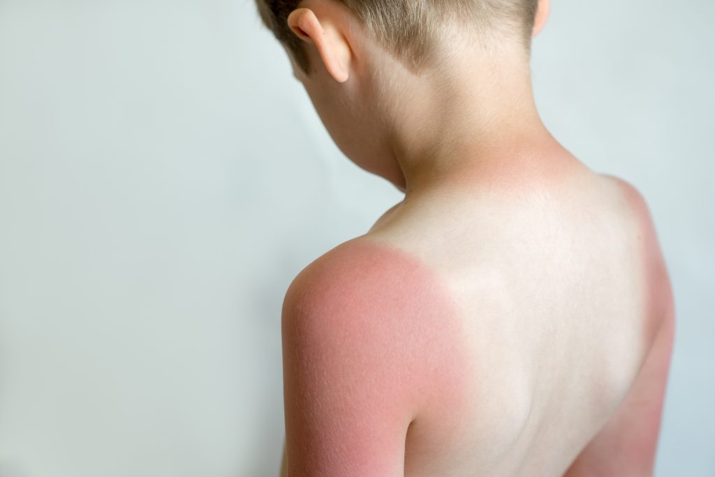 Keys to Sunburn Prevention: Symptoms, Causes & Remedies