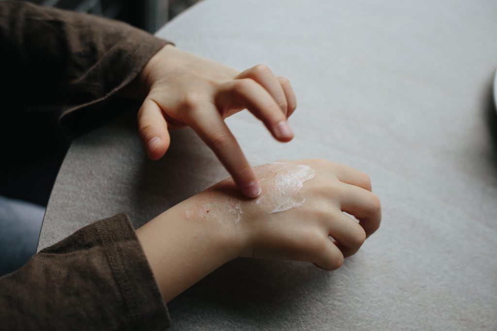 A small child smears redness on the hand with baby cream. The concept of treatment and skin care with cream, frostbite and peeling skin