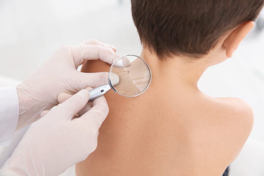 Dermatologist examining little boy's birthmark with magnifying glass in clinic, closeup