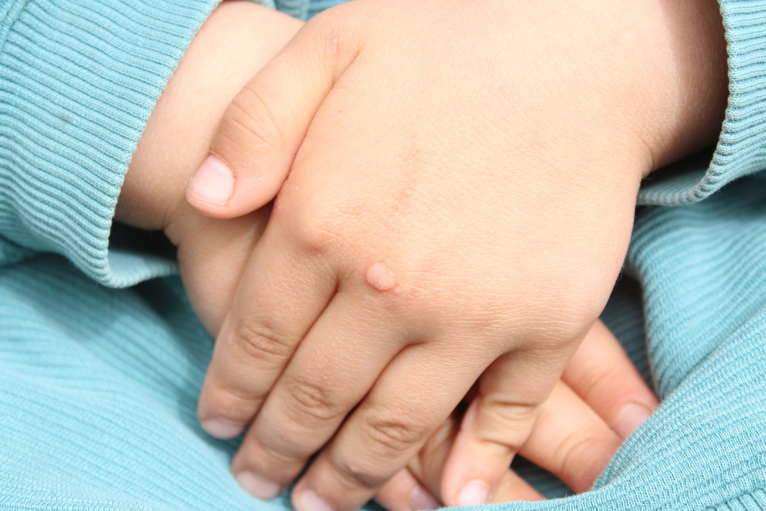 Molluscum Contagiosum Or Hpv? Spot The Difference - 2bq23lv