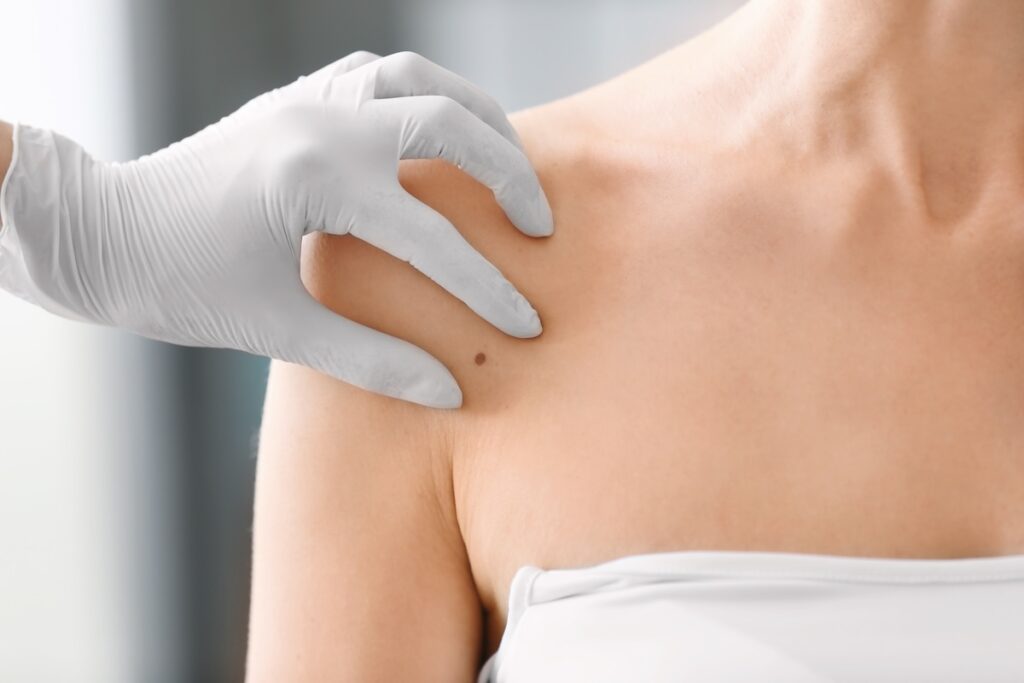 Dermatologist examining birthmark of patient, closeup. Cancer concept