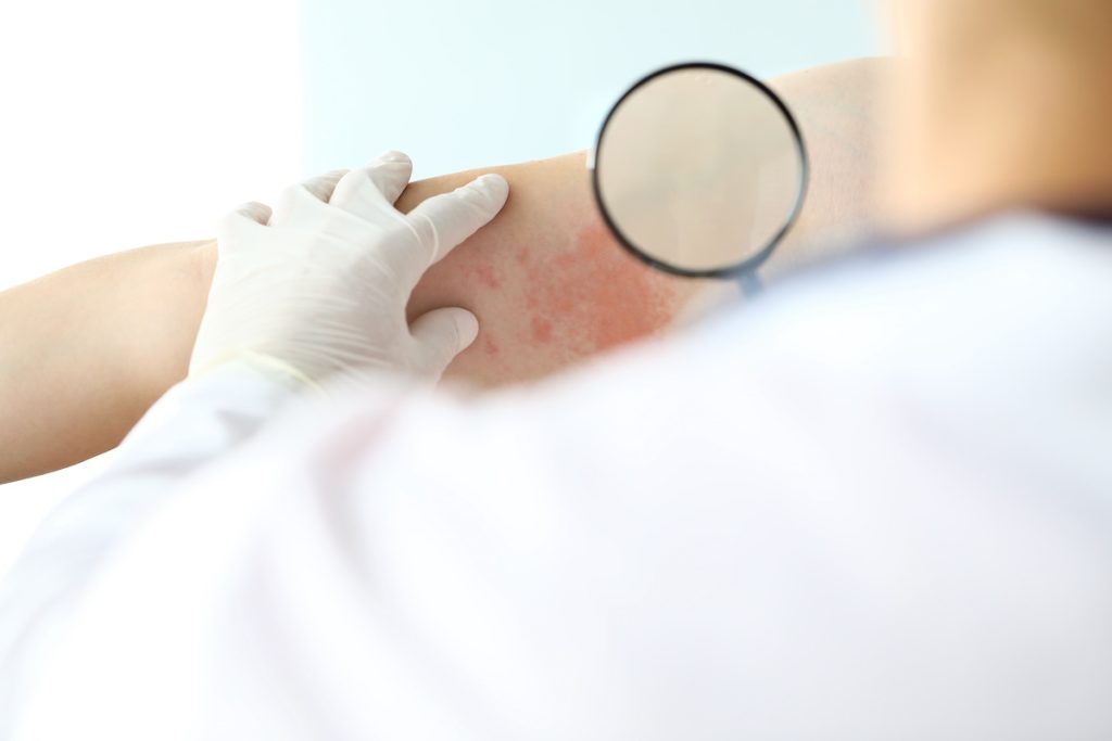 Dermatologist using a magnifying glass to examine a red rash on a patient's arm, focusing on diagnosing skin conditions like shingles