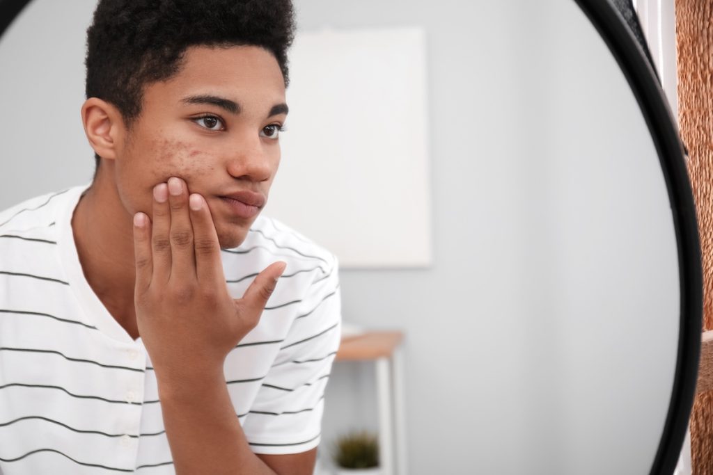 Teenager with acne looking at their reflection in a mirror.