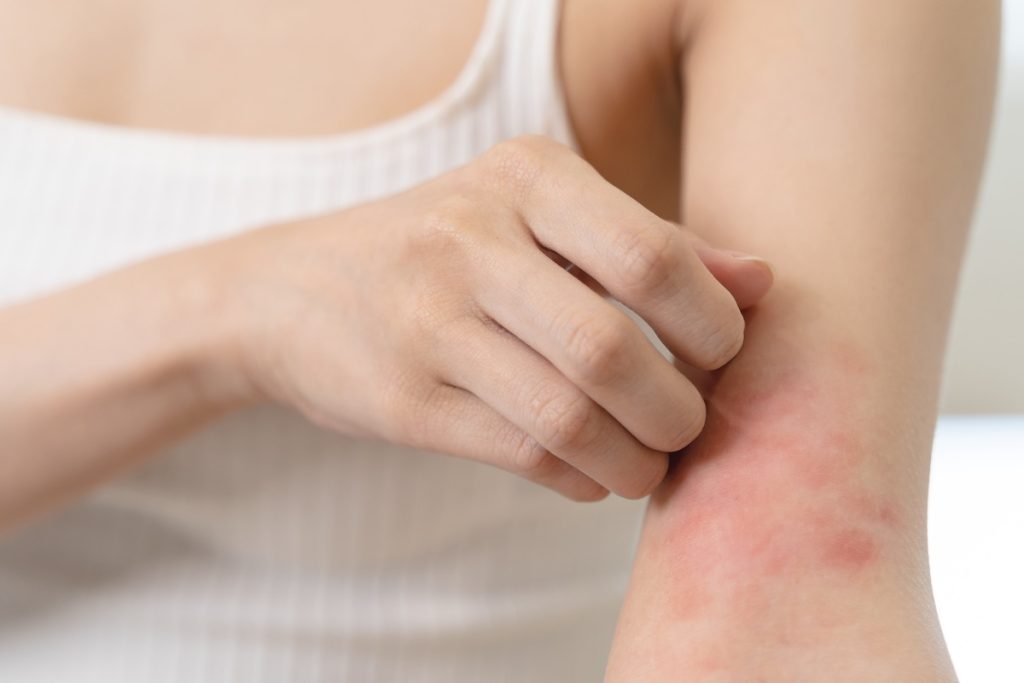 Woman itching a rash on her arm