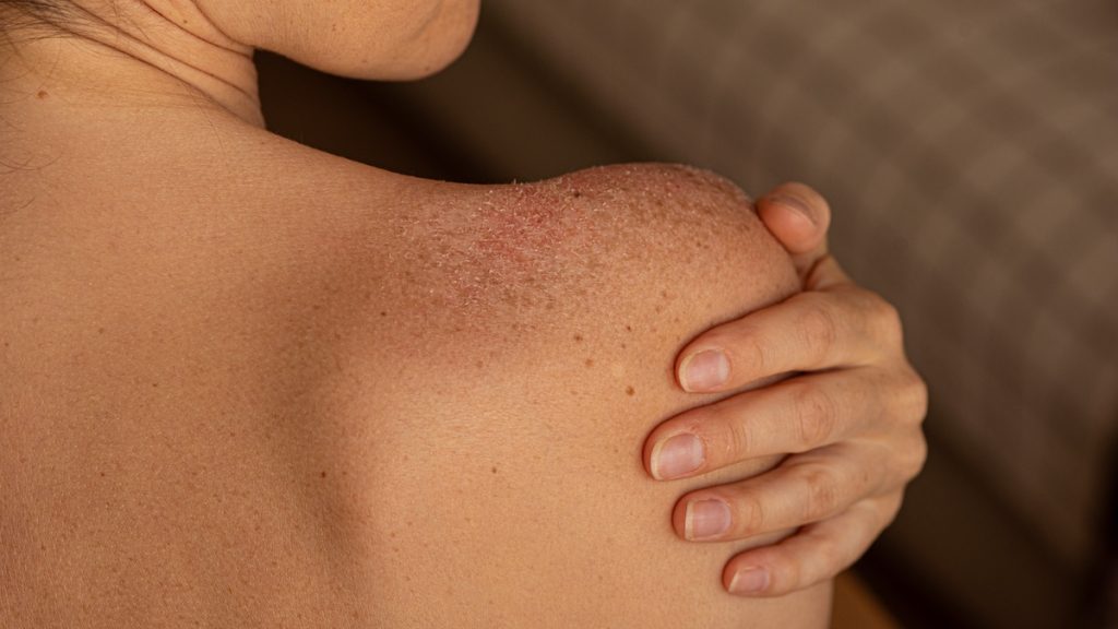 skin peeling on woman's shoulders, sunburn, pain, unhealthy, uv close up of woman's shoulder with heat rash