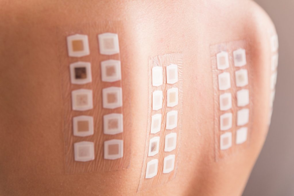 Alergy patch test on the back of a young woman