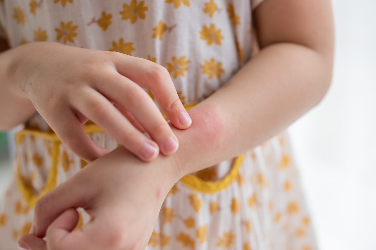 Common Viral Rashes in Children: What to Know
