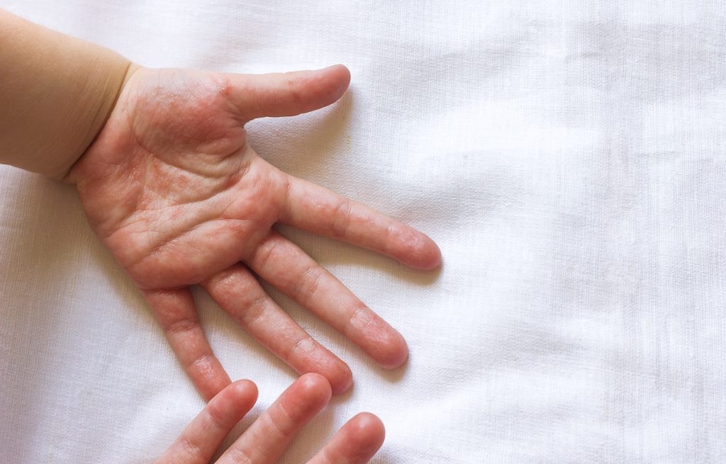 Red rash on children's hands on a white background
