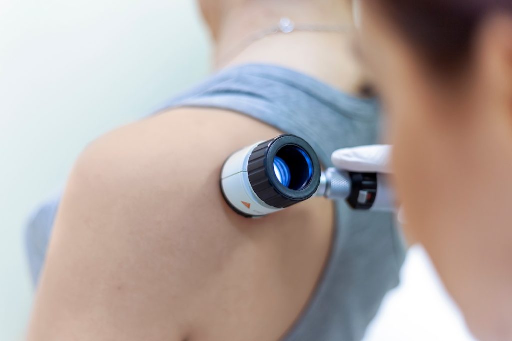 dermatologist examines birthmarks on the patient's skin with a dermatoscope. Dermatology, skin mole examining. looking for signs of melonoma or skin cancer.